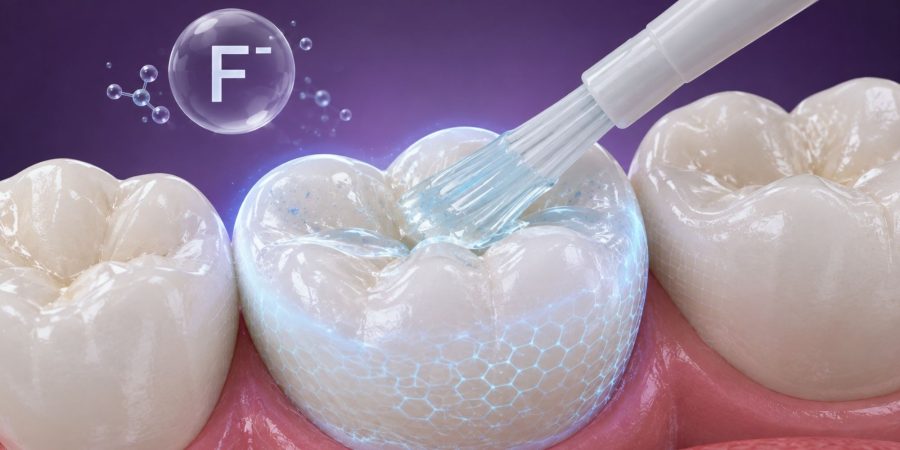 Aplicación-de-Fluor-Clínica-Dental-DUOAM-Coatepec-Veracruz