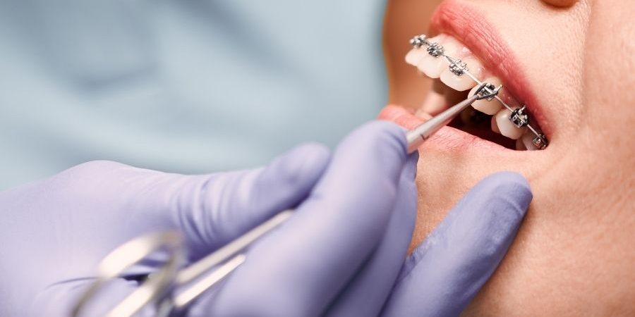 Brackets-revisión-DUOAM-Clínica-dental