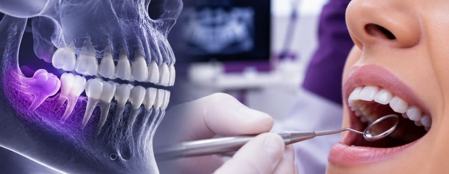 Cirugía-Dentoalveolar-clínica-dental-duoam-coatepec-veracruz