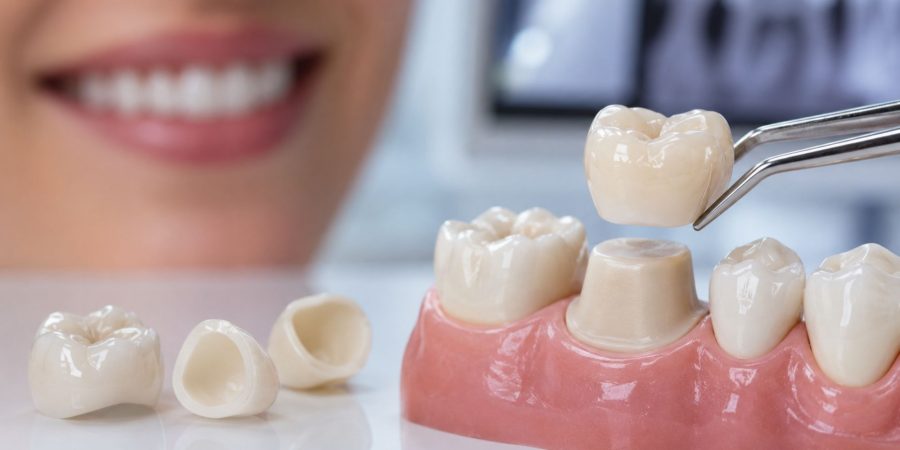 Coronas-Dentales-Coatepec-Clínica-dental-DUOAM