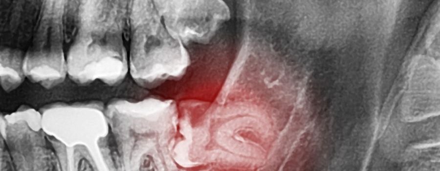 Muelas-del-juicio-DUOAM-Clínica-dental